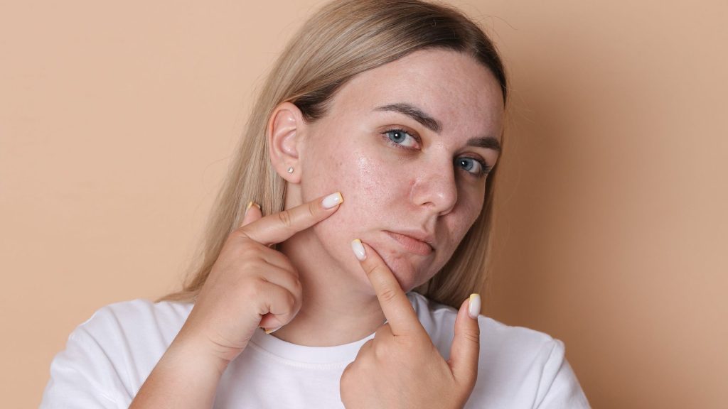 From Acne to Irregular Periods Hormonal Signs You Shouldn’t Ignore